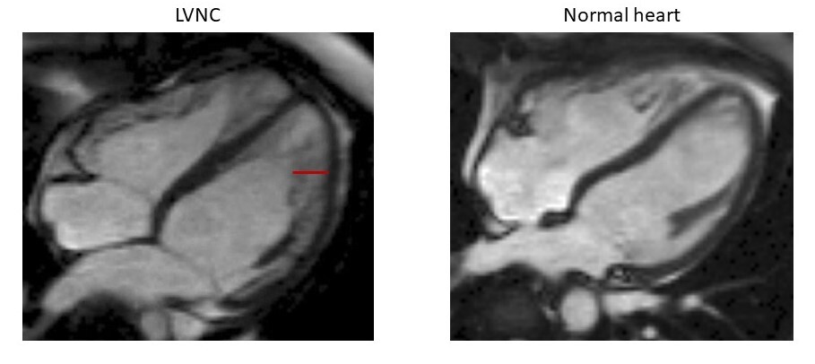 Cardiac magnetic resonance imaging in the diagnosis of biventricular  non-compaction in a young but failing heart